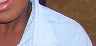 visual impairment